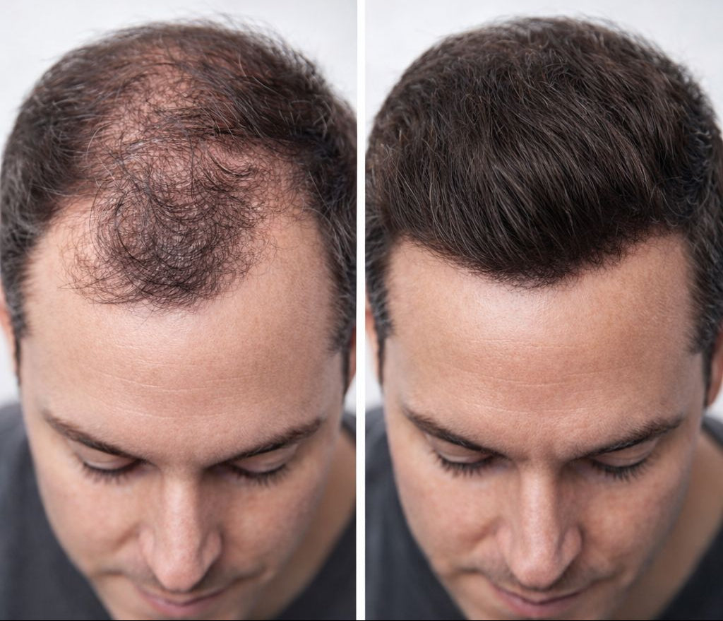 Camouflage capillaire